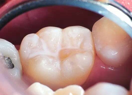 【福州】六龄齿是什么牙？