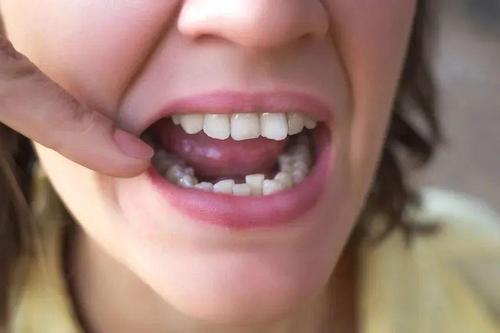 【福州】关于牙齿矫正是否可以做半口的问题