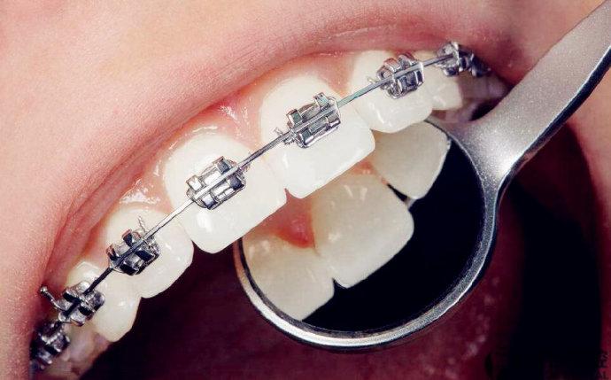 【福州】做完根管治疗后还能做牙齿矫正吗？
