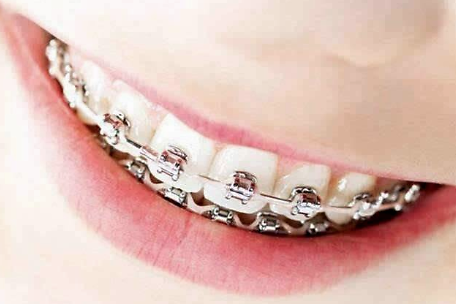 【福州】关于牙齿矫正需要注意的事项