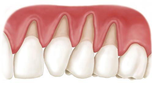【福州】牙龈萎缩有哪些原因？