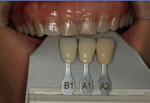 【福州】洗牙能否让四环素牙恢复正常？