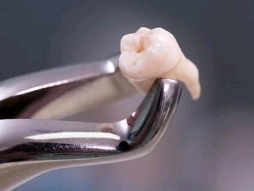【福州】拔牙后需要等多久才能用拔牙侧咀嚼？