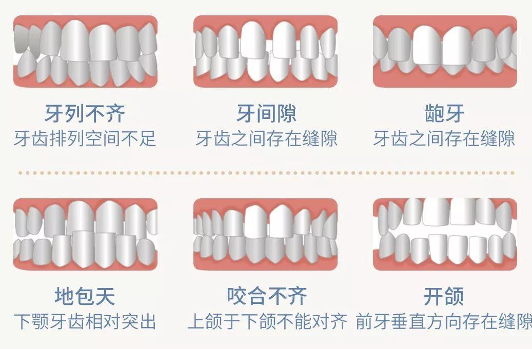 【福州】造成牙齿畸形的原因有哪些？