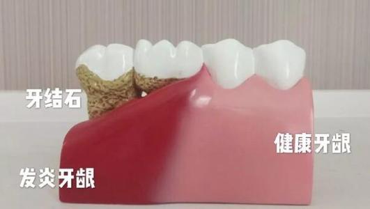 【福州】洗牙会造成疼痛吗？