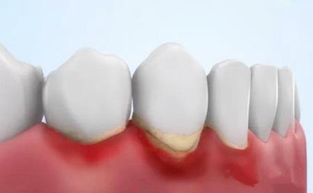 【福州】有哪些症状表示牙周炎正在发生？