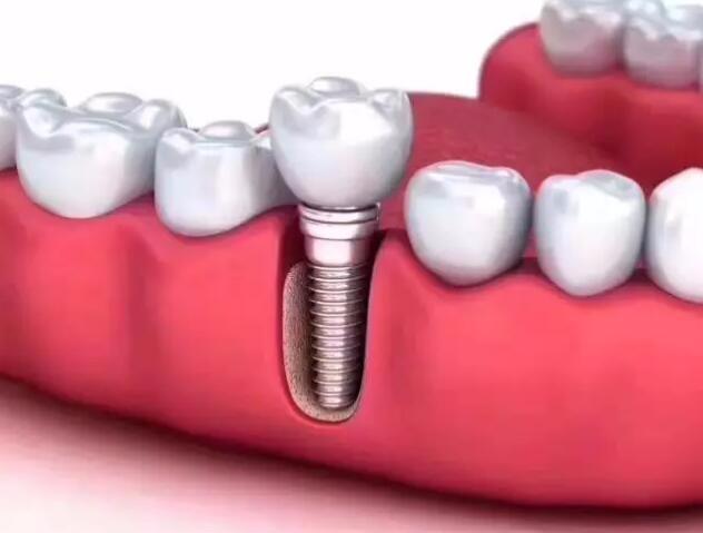 【福州】如何有效延长种植牙的使用寿命？